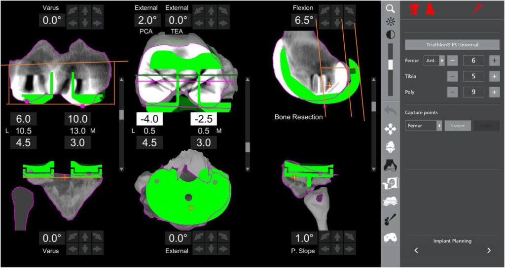 Images of robotic knee implant surgery